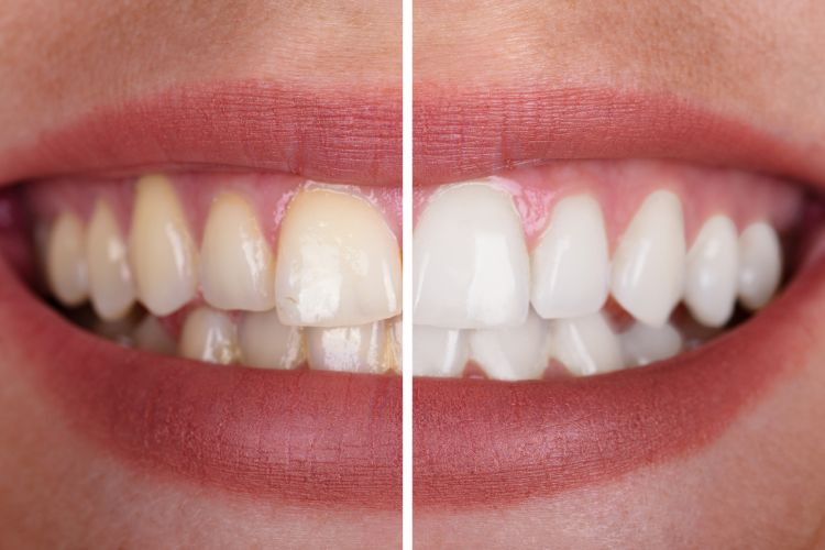 blanquemiento dental antes y despues