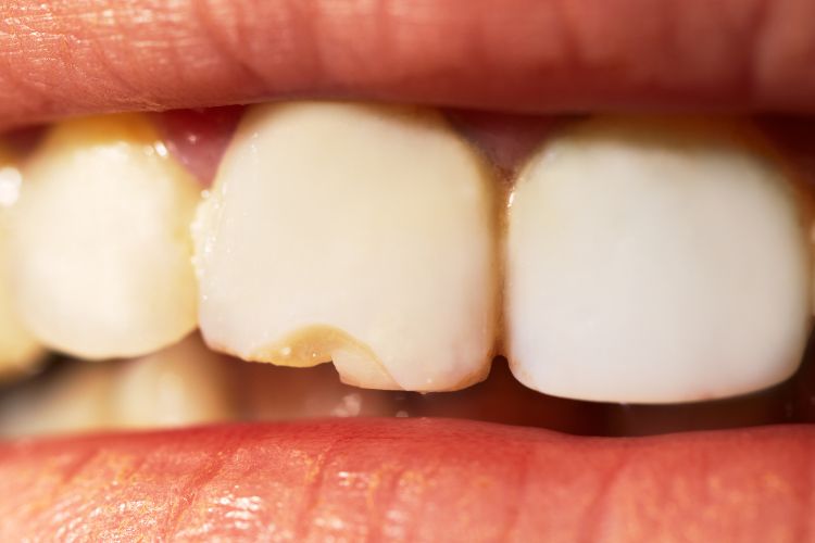 fractura de un diente